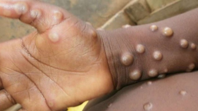 Cazurile de variola maimuței din SUA ar fi mai multe decât raportează CDC